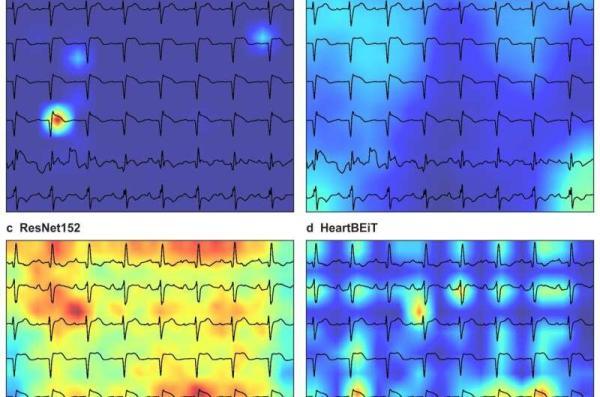هوش مصنوعی نوار قلب را می خواند و بیماری را تشخیص می دهد